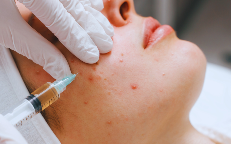 How to Get Rid of Acne Scars Effective Treatments and Techniques
